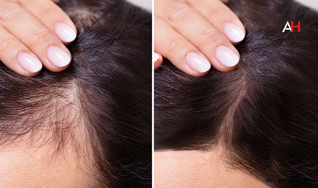 Saçlarım çok dökülüyor ne yapmam lazım?