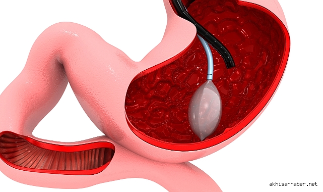 Yutulabilir Mide Balonu