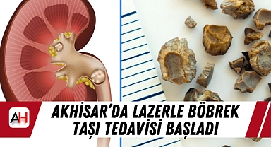 Akhisar'da Lazerle Böbrek Taşı Tedavisi Başladı